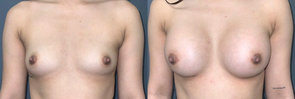 Real Patient Results in Newport Beach, CA. Preformed by Semira Bayait, MD, FACS.