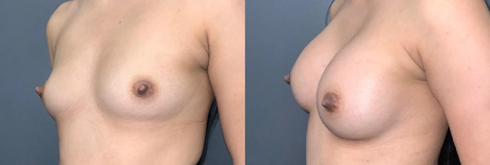 Real Patient Results in Newport Beach, CA. Preformed by Semira Bayait, MD, FACS.