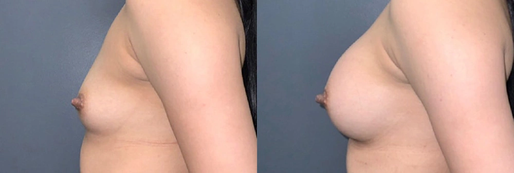 Real Patient Results in Newport Beach, CA. Preformed by Semira Bayait, MD, FACS.