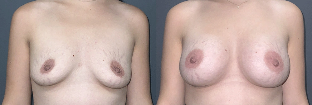 Real Patient Results in Newport Beach, CA. Preformed by Semira Bayait, MD, FACS.