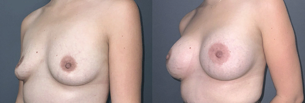 Real Patient Results in Newport Beach, CA. Preformed by Semira Bayait, MD, FACS.