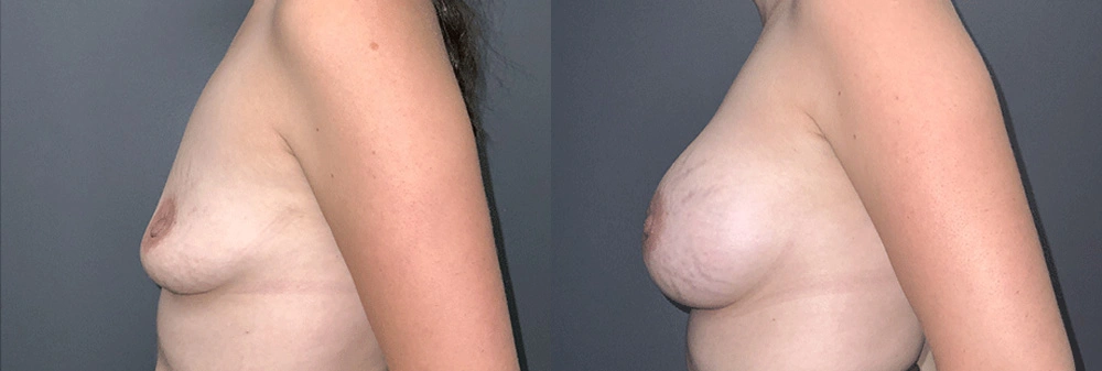 Real Patient Results in Newport Beach, CA. Preformed by Semira Bayait, MD, FACS.
