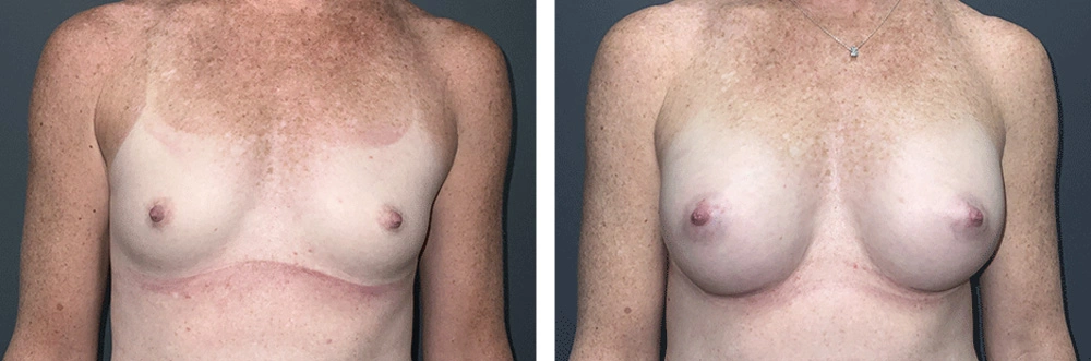 Real Patient Results in Newport Beach, CA. Preformed by Semira Bayait, MD, FACS.