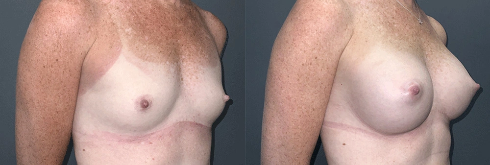 Real Patient Results in Newport Beach, CA. Preformed by Semira Bayait, MD, FACS.