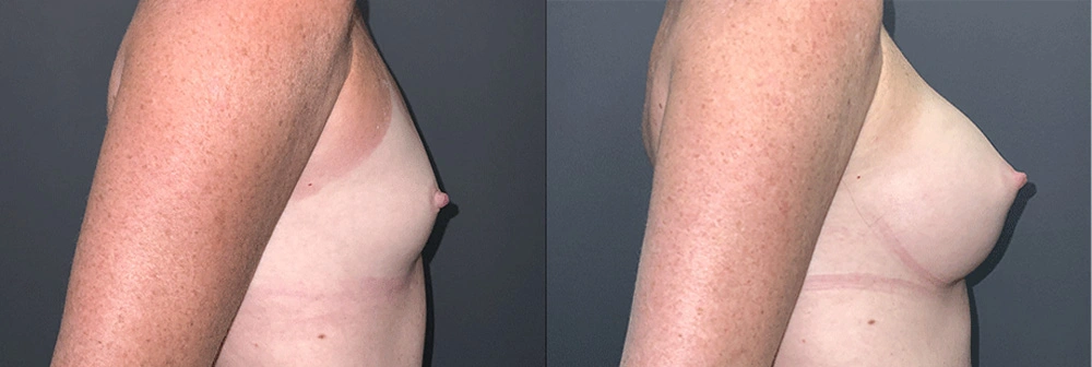 Real Patient Results in Newport Beach, CA. Preformed by Semira Bayait, MD, FACS.