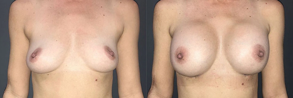Real Patient Results in Newport Beach, CA. Preformed by Semira Bayait, MD, FACS.