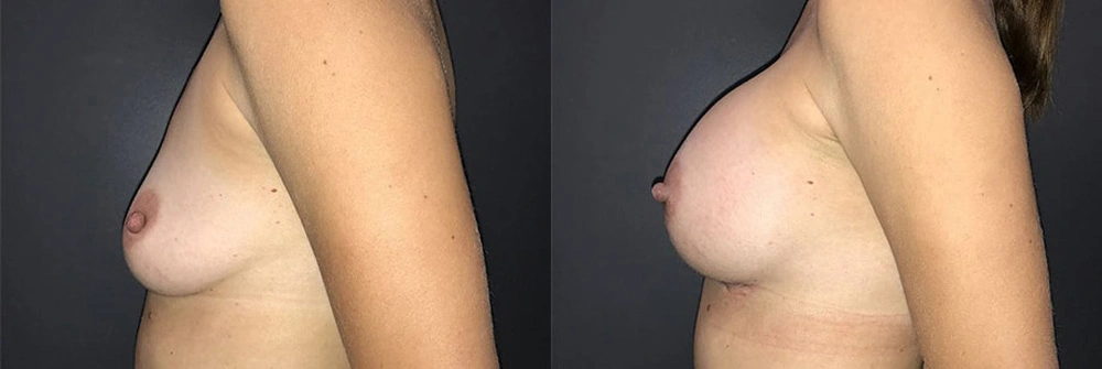 Real Patient Results in Newport Beach, CA. Preformed by Semira Bayait, MD, FACS.