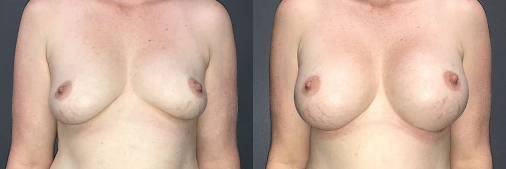 Real Patient Results in Newport Beach, CA. Preformed by Semira Bayait, MD, FACS.