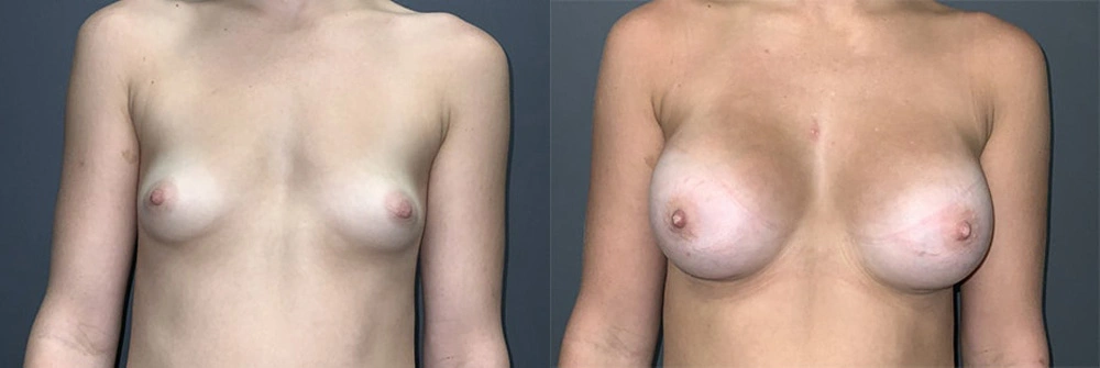 Real Patient Results in Newport Beach, CA. Preformed by Semira Bayait, MD, FACS.
