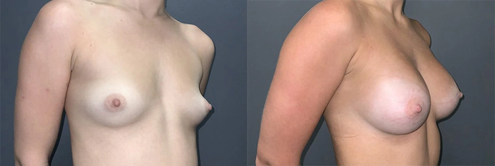 Real Patient Results in Newport Beach, CA. Preformed by Semira Bayait, MD, FACS.