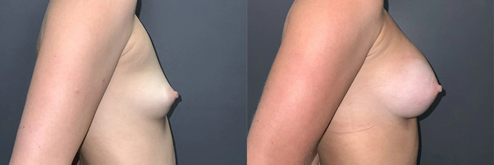 Real Patient Results in Newport Beach, CA. Preformed by Semira Bayait, MD, FACS.