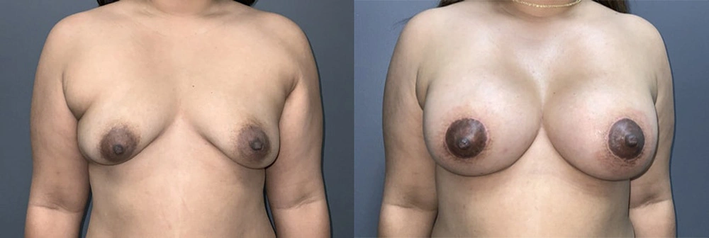 Real Patient Results in Newport Beach, CA. Preformed by Semira Bayait, MD, FACS.
