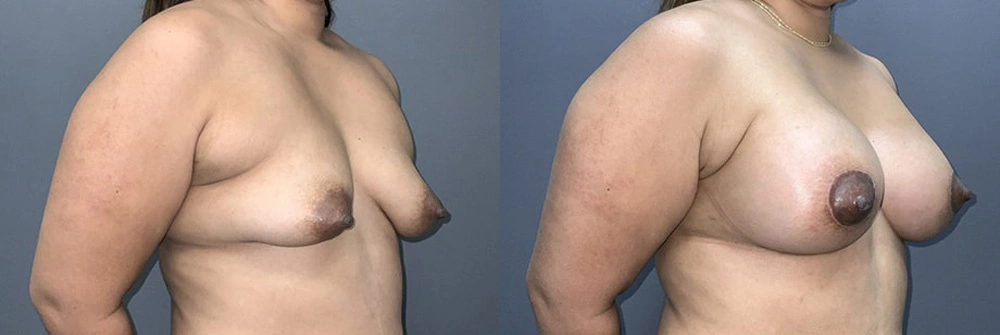 Real Patient Results in Newport Beach, CA. Preformed by Semira Bayait, MD, FACS.