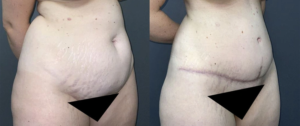 Real Patient Results in Newport Beach, CA. Preformed by Semira Bayait, MD, FACS.