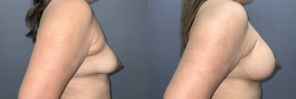 Real Patient Results in Newport Beach, CA. Preformed by Semira Bayait, MD, FACS.