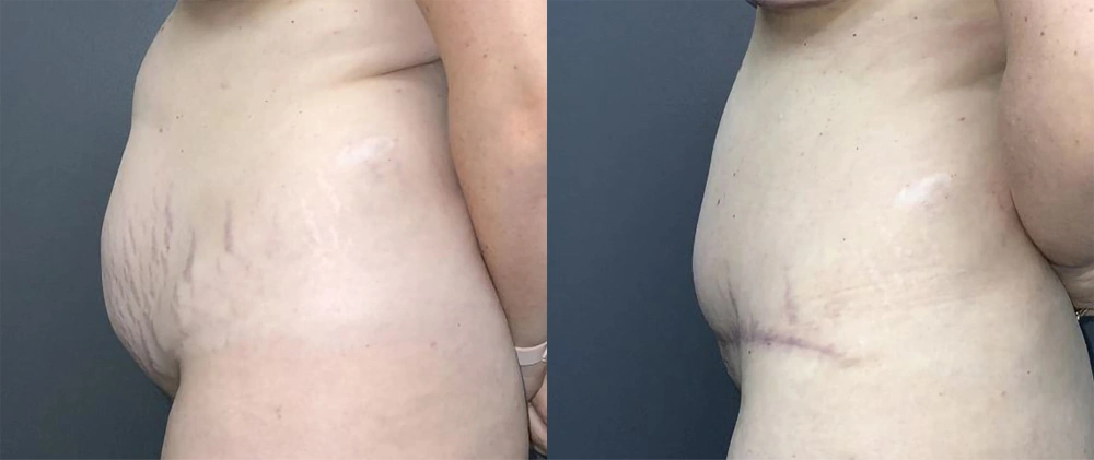 Real Patient Results in Newport Beach, CA. Preformed by Semira Bayait, MD, FACS.
