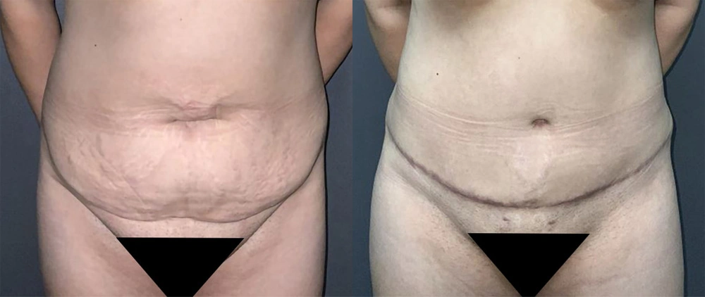 Real Patient Results in Newport Beach, CA. Preformed by Semira Bayait, MD, FACS.
