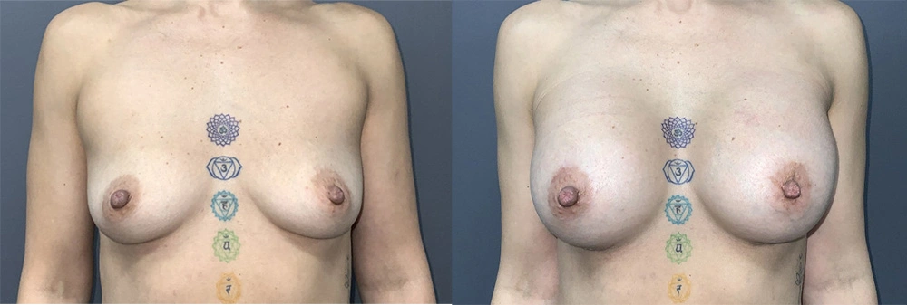 Real Patient Results in Newport Beach, CA. Preformed by Semira Bayait, MD, FACS.