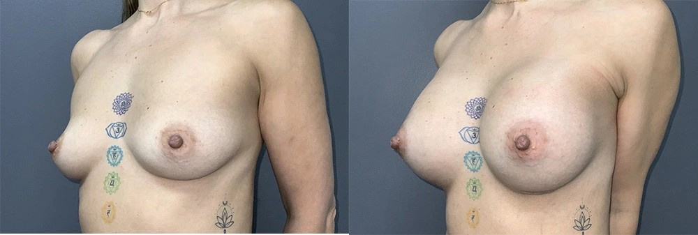 Real Patient Results in Newport Beach, CA. Preformed by Semira Bayait, MD, FACS.