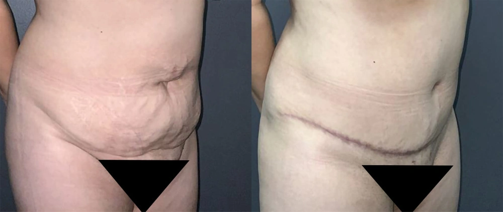 Real Patient Results in Newport Beach, CA. Preformed by Semira Bayait, MD, FACS.