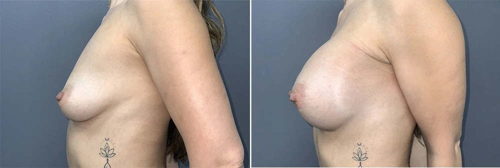 Real Patient Results in Newport Beach, CA. Preformed by Semira Bayait, MD, FACS.
