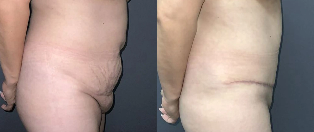 Real Patient Results in Newport Beach, CA. Preformed by Semira Bayait, MD, FACS.