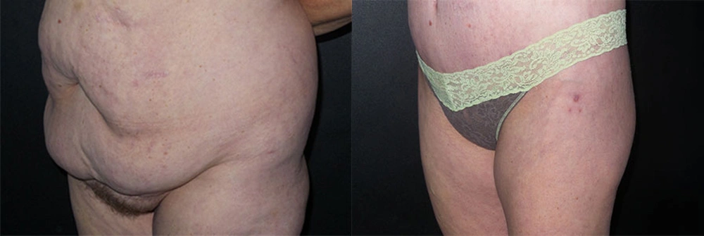Real Patient Results in Newport Beach, CA. Preformed by Semira Bayait, MD, FACS.