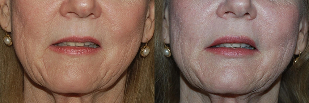 Real Patient Results in Newport Beach, CA. Preformed by Semira Bayait, MD, FACS.