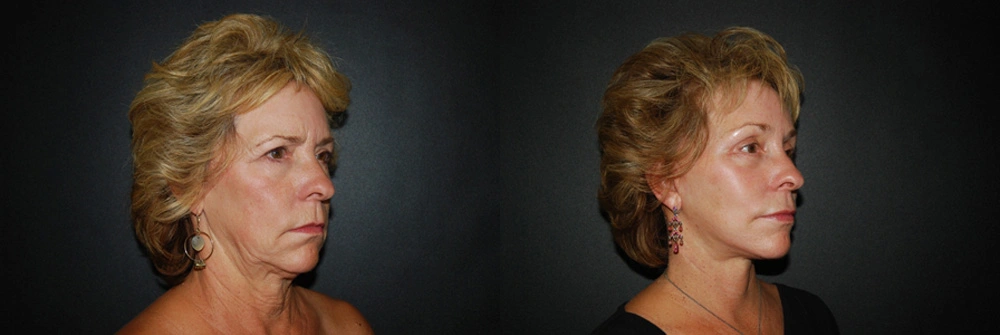 Real Patient Results in Newport Beach, CA. Preformed by Semira Bayait, MD, FACS.