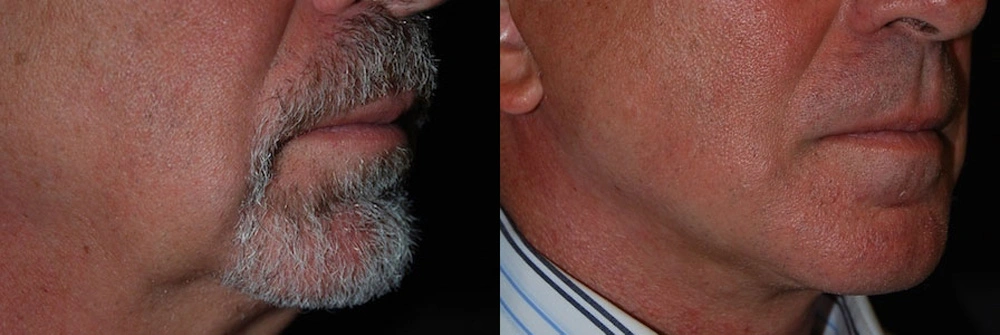 Real Patient Results in Newport Beach, CA. Preformed by Semira Bayait, MD, FACS.