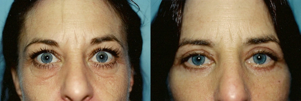 Real Patient Results in Newport Beach, CA. Preformed by Semira Bayait, MD, FACS.