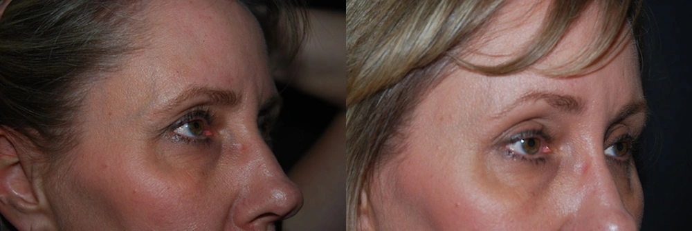 Real Patient Results in Newport Beach, CA. Preformed by Semira Bayait, MD, FACS.