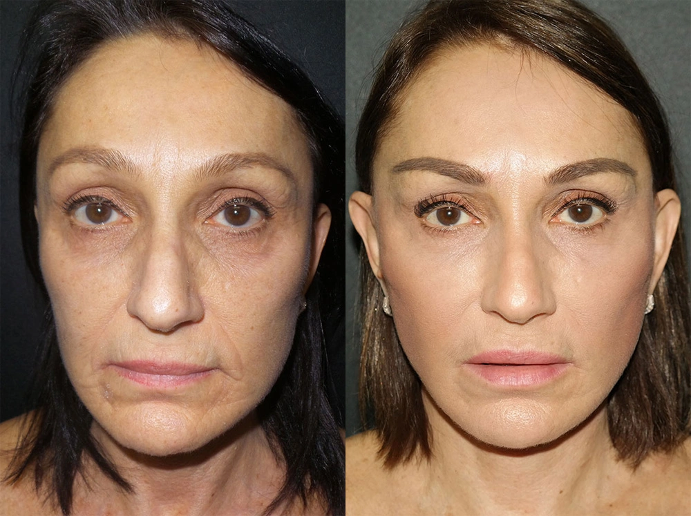 Real Patient Results in Newport Beach, CA. Preformed by Semira Bayait, MD, FACS.