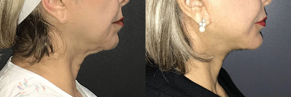Real Patient Results in Newport Beach, CA. Preformed by Semira Bayait, MD, FACS.