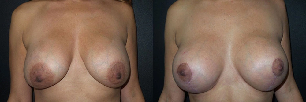 Real Patient Results in Newport Beach, CA. Preformed by Semira Bayait, MD, FACS.