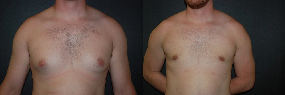 Real Patient Results in Newport Beach, CA. Preformed by Semira Bayait, MD, FACS.