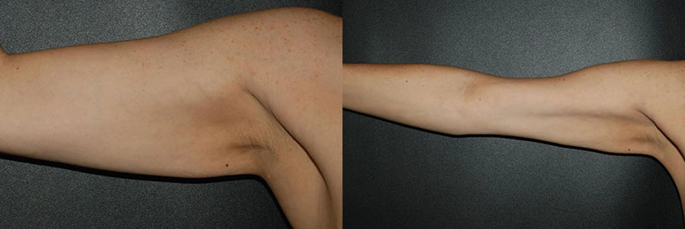 Real Patient Results in Newport Beach, CA. Preformed by Semira Bayait, MD, FACS.
