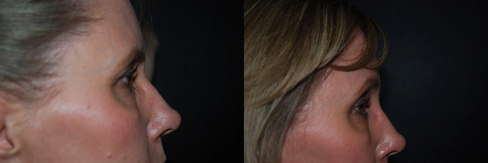 Real Patient Results in Newport Beach, CA. Preformed by Semira Bayait, MD, FACS.
