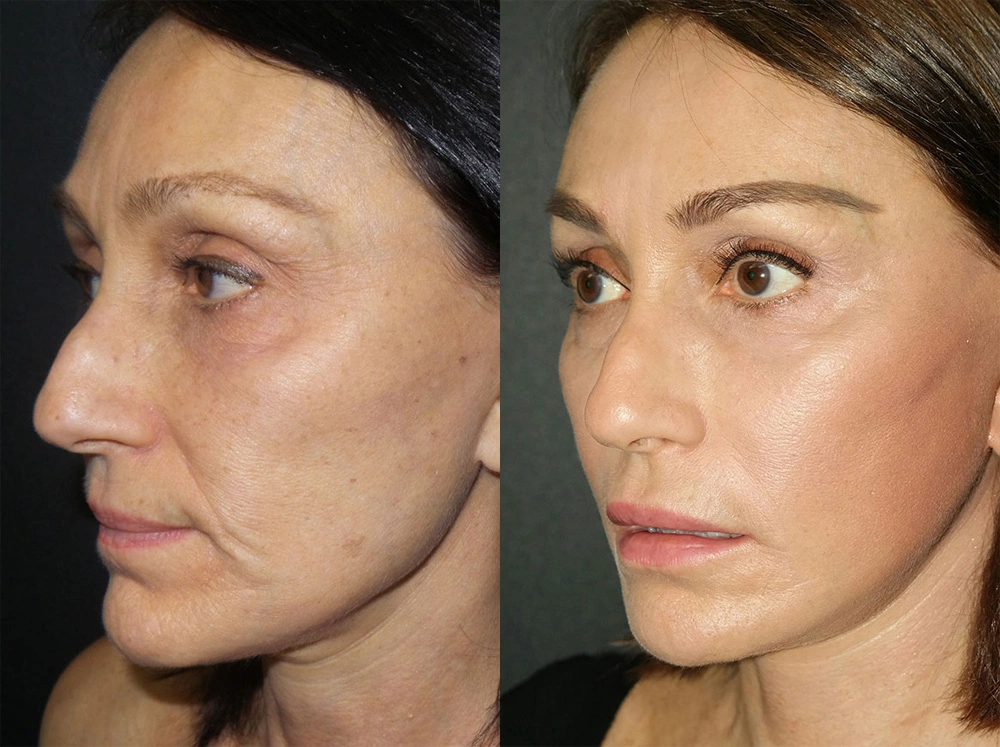 Real Patient Results in Newport Beach, CA. Preformed by Semira Bayait, MD, FACS.