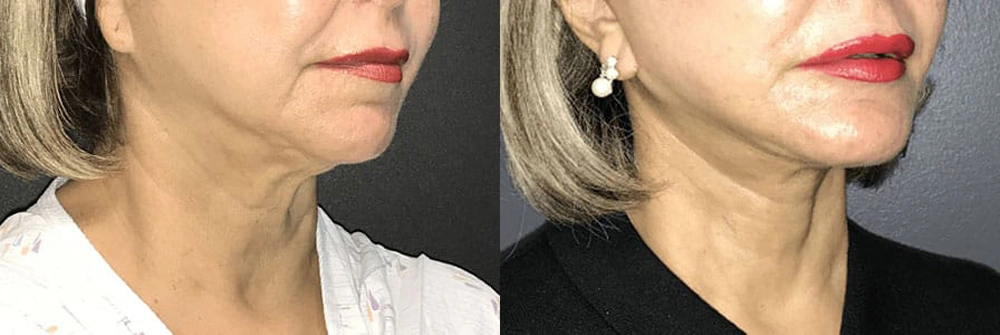 Real Patient Results in Newport Beach, CA. Preformed by Semira Bayait, MD, FACS.