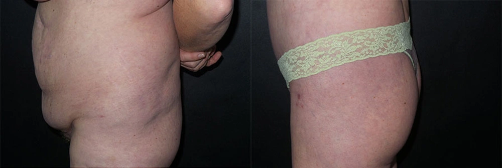Real Patient Results in Newport Beach, CA. Preformed by Semira Bayait, MD, FACS.