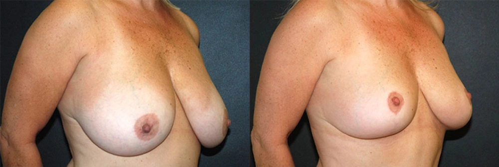 Real Patient Results in Newport Beach, CA. Preformed by Semira Bayait, MD, FACS.