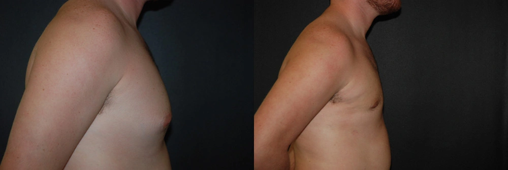 Real Patient Results in Newport Beach, CA. Preformed by Semira Bayait, MD, FACS.