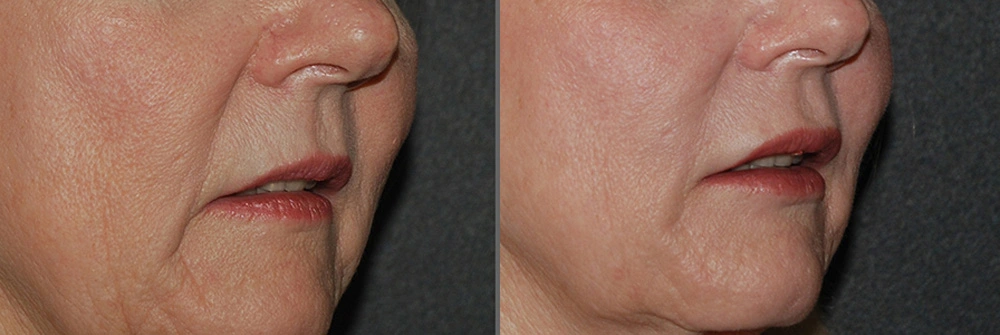 Real Patient Results in Newport Beach, CA. Preformed by Semira Bayait, MD, FACS.