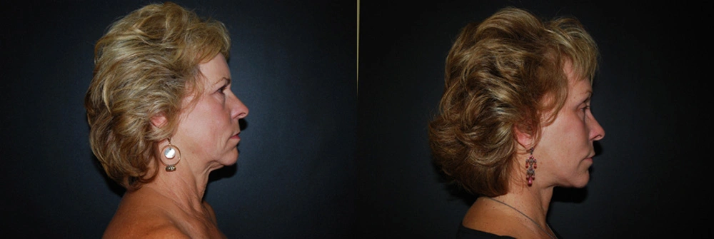 Real Patient Results in Newport Beach, CA. Preformed by Semira Bayait, MD, FACS.