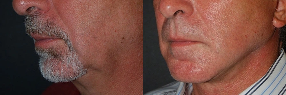 Real Patient Results in Newport Beach, CA. Preformed by Semira Bayait, MD, FACS.