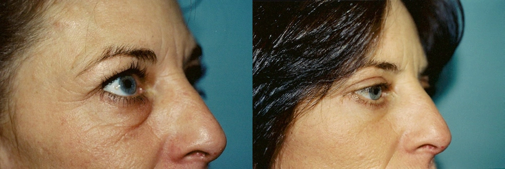 Real Patient Results in Newport Beach, CA. Preformed by Semira Bayait, MD, FACS.