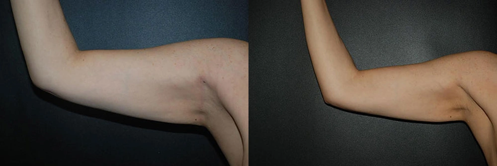 Real Patient Results in Newport Beach, CA. Preformed by Semira Bayait, MD, FACS.