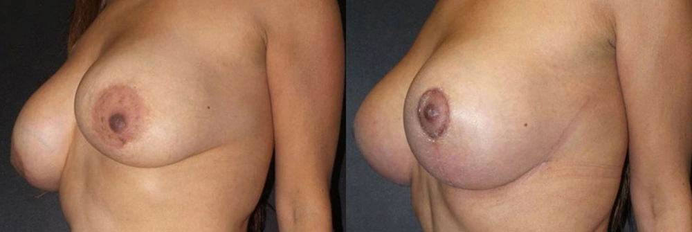 Real Patient Results in Newport Beach, CA. Preformed by Semira Bayait, MD, FACS.