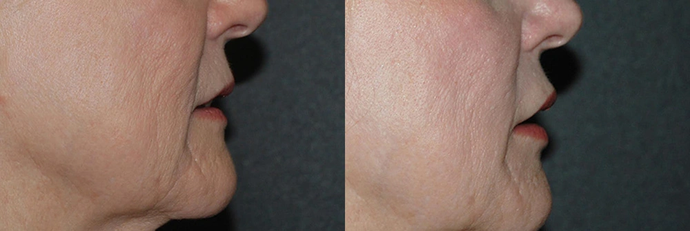 Real Patient Results in Newport Beach, CA. Preformed by Semira Bayait, MD, FACS.